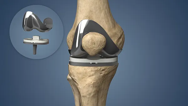 Total Knee Replacement